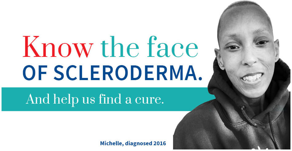 Know the face of Scleroderma. And help us find a cure. - Michelle, diagnosed 2016